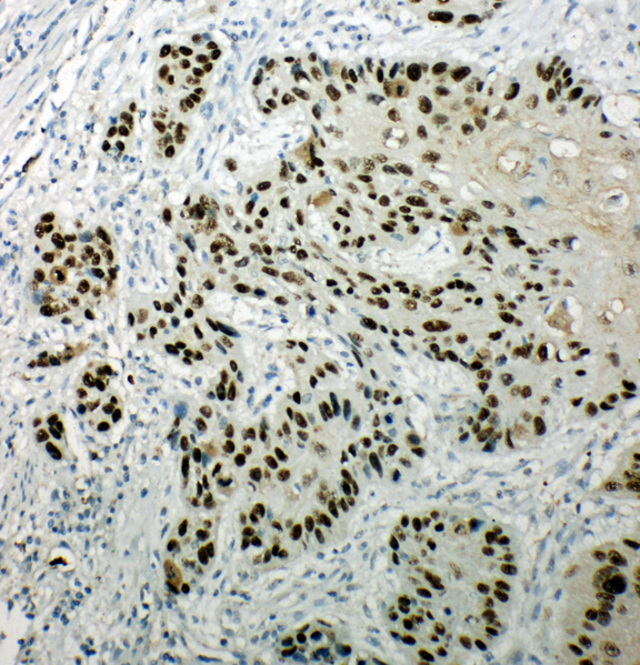TP63 / p63 Antibody - TP63 / p63 antibody. IHC(P): Human Esophageal Squamous Cell Carcinoma Tissue.