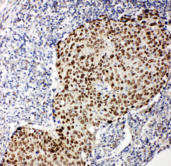TP63 / p63 Antibody - TP63 / p63 antibody. IHC(P): Human Lung Cancer Tissue.