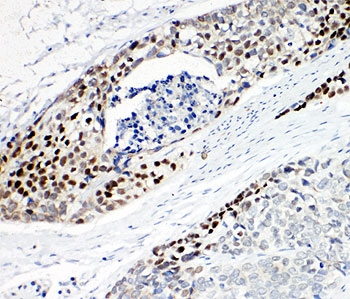 TP63 / p63 Antibody - IHC-P: p63 antibody testing of human esophageal squamous cell carcinoma tissue