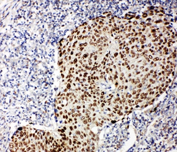 TP63 / p63 Antibody - IHC-P testing of human lung cancer tissue