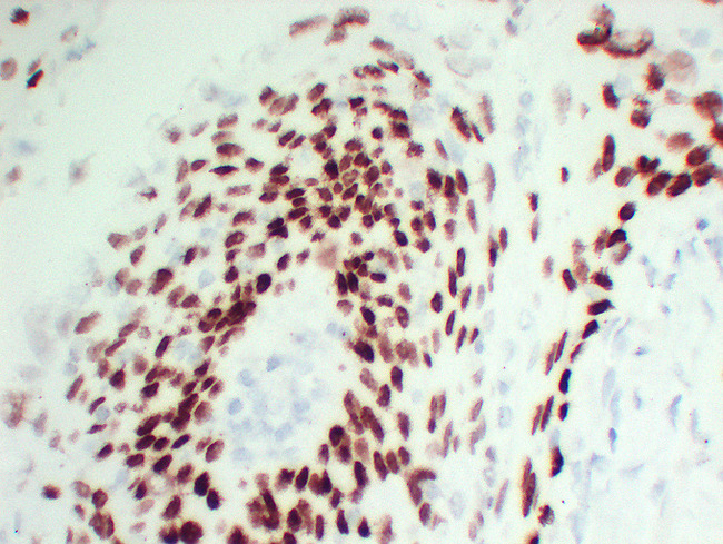 TP63 / p63 Antibody - Cervical Squamous Cell Carcinoma High Magnification