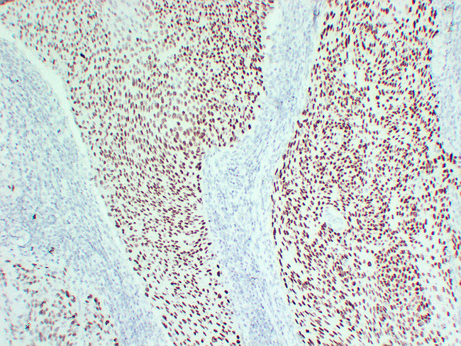 TP63 / p63 Antibody - Cervical Squamous Cell Carcinoma