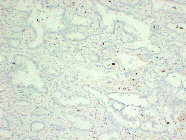 TP63 / p63 Antibody - Lung Adenocarcinoma