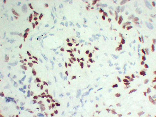 TP63 / p63 Antibody - Lung Squamous Cell Carcinoma 1 High Magnification