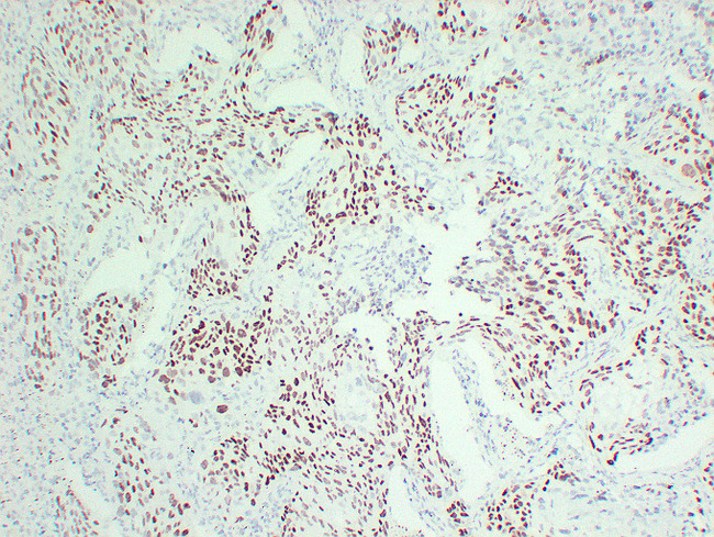 TP63 / p63 Antibody - Lung Squamous Cell Carcinoma 1