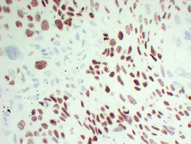 TP63 / p63 Antibody - Lung Squamous Cell Carcinoma 2 High Magnification