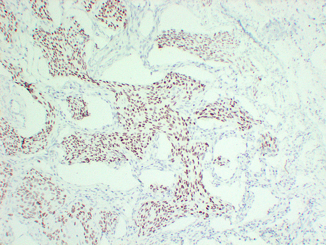 TP63 / p63 Antibody - Lung Squamous Cell Carcinoma 2