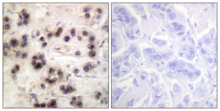 TP63 / p63 Antibody - Immunohistochemistry analysis of paraffin-embedded human breast carcinoma, using p63 (Phospho-Ser455) Antibody. The picture on the right is blocked with the phospho peptide.