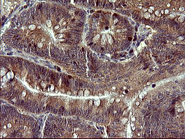 TP73 / p73 Antibody - IHC of paraffin-embedded Carcinoma of Human pancreas tissue using anti-TP73 mouse monoclonal antibody. (Heat-induced epitope retrieval by 10mM citric buffer, pH6.0, 120°C for 3min).