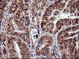 TP73 / p73 Antibody - IHC of paraffin-embedded Carcinoma of Human pancreas tissue using anti-TP73 mouse monoclonal antibody.