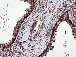 TP73 / p73 Antibody - IHC of paraffin-embedded Carcinoma of Human prostate tissue using anti-TP73 mouse monoclonal antibody.