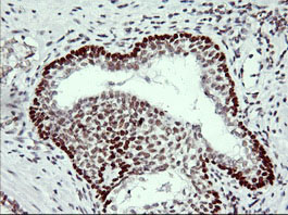 TP73 / p73 Antibody - IHC of paraffin-embedded Carcinoma of Human prostate tissue using anti-TP73 mouse monoclonal antibody.