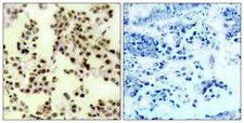 TP73 / p73 Antibody - Immunohistochemistry analysis of paraffin-embedded human lung carcinoma, using p73 (Phospho-Tyr99) Antibody. The picture on the right is blocked with the phospho peptide.