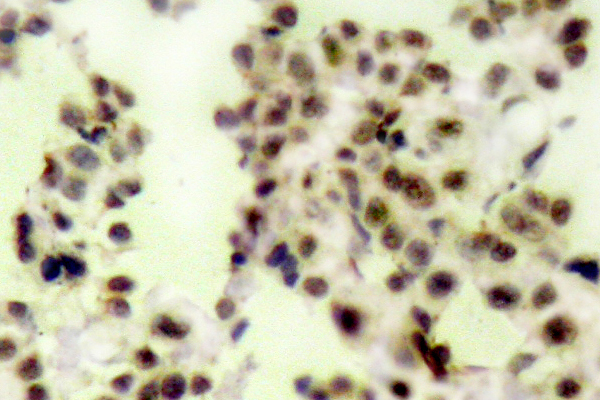 TP73 / p73 Antibody - IHC of p-p73 (Y99) pAb in paraffin-embedded human breast carcinoma tissue.