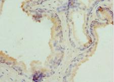 TPD52L1 Antibody - Immunohistochemistry of paraffin-embedded human prostata cancer at dilution 1:100