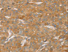 TPD52L2 / HD54 Antibody - Immunohistochemistry of paraffin-embedded Human liver cancer using TPD52L2 Polyclonal Antibody at dilution of 1:35.
