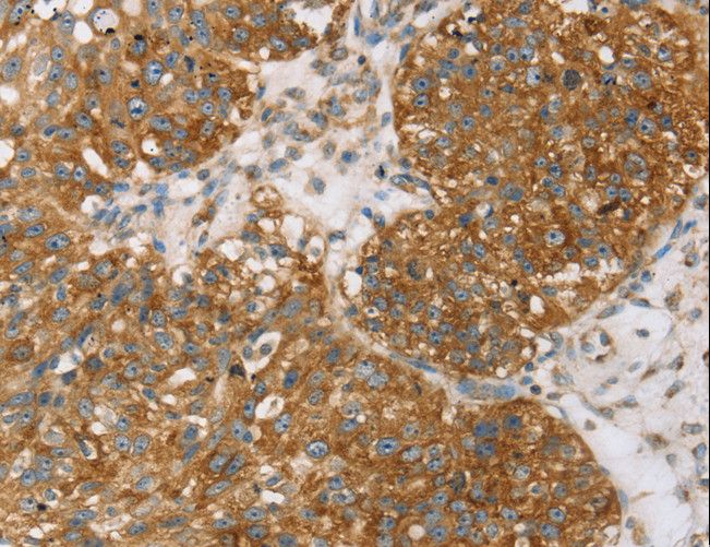 TPD52L2 / HD54 Antibody - Immunohistochemistry of paraffin-embedded Human breast cancer using TPD52L2 Polyclonal Antibody at dilution of 1:35.