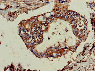 TPD52L2 / HD54 Antibody - Immunohistochemistry of paraffin-embedded human pancreatic cancer at dilution of 1:100