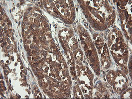 TPD52L3 Antibody - IHC of paraffin-embedded Carcinoma of Human thyroid tissue using anti-TPD52L3 mouse monoclonal antibody.