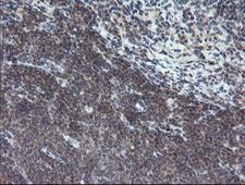 TPD52L3 Antibody - IHC of paraffin-embedded Human lymphoma tissue using anti-TPD52L3 mouse monoclonal antibody.