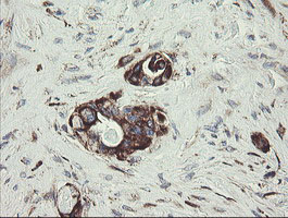TPD52L3 Antibody - IHC of paraffin-embedded Adenocarcinoma of Human colon tissue using anti-TPD52L3 mouse monoclonal antibody.