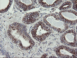 TPD52L3 Antibody - IHC of paraffin-embedded Carcinoma of Human prostate tissue using anti-TPD52L3 mouse monoclonal antibody.