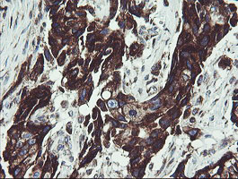 TPD52L3 Antibody - IHC of paraffin-embedded Adenocarcinoma of Human breast tissue using anti-TPD52L3 mouse monoclonal antibody.
