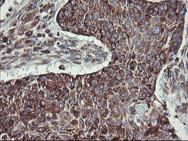 TPD52L3 Antibody - IHC of paraffin-embedded Carcinoma of Human lung tissue using anti-TPD52L3 mouse monoclonal antibody.