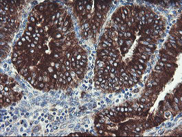 TPD52L3 Antibody - IHC of paraffin-embedded Adenocarcinoma of Human endometrium tissue using anti-TPD52L3 mouse monoclonal antibody.
