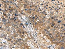 TPD52L3 Antibody - Immunohistochemistry of paraffin-embedded Human liver cancer tissue  using TPD52L3 Polyclonal Antibody at dilution of 1:140(×200)