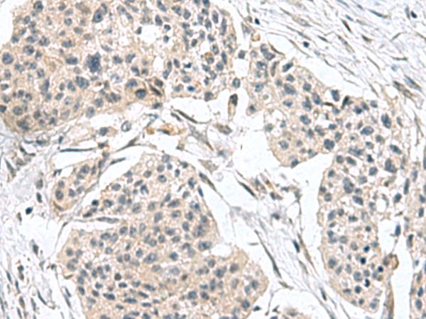 TPD52L3 Antibody - Immunohistochemistry of paraffin-embedded Human esophagus cancer tissue  using TPD52L3 Polyclonal Antibody at dilution of 1:140(×200)