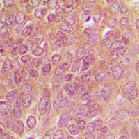 TPH1 / Tryptophan Hydroxylase Antibody - Immunohistochemical analysis of TPH1 staining in human breast cancer formalin fixed paraffin embedded tissue section. The section was pre-treated using heat mediated antigen retrieval with sodium citrate buffer (pH 6.0). The section was then incubated with the antibody at room temperature and detected using an HRP polymer system. DAB was used as the chromogen. The section was then counterstained with hematoxylin and mounted with DPX.