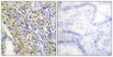 TPH1 / Tryptophan Hydroxylase Antibody - Peptide - + Immunohistochemistry analysis of paraffin-embedded human lung carcinoma tissue using Tryptophan Hydroxylase (Ab-260) antibody.