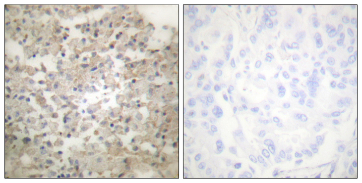 TPH1 / Tryptophan Hydroxylase Antibody - Immunohistochemistry analysis of paraffin-embedded human lung carcinoma, using Tryptophan Hydroxylase (Phospho-Ser260) Antibody. The picture on the right is blocked with the phospho peptide.