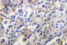 TPH1 / Tryptophan Hydroxylase Antibody - IHC of TPH1 (V256) pAb in paraffin-embedded human lung carcinoma tissue.