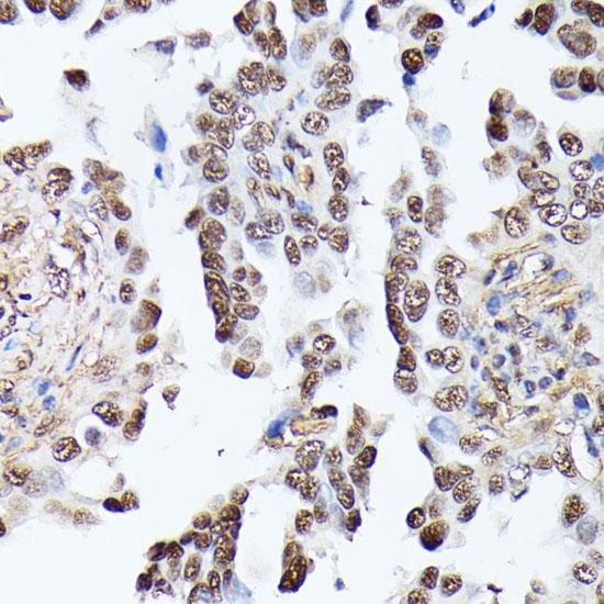TPI1 / TPI Antibody - Immunohistochemistry of paraffin-embedded Human lung cancer using TPI1 Polyclonal Antibody at dilution of 1:100 (40x lens).