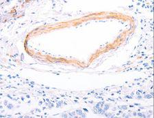 TPM1 / Tropomyosin Antibody - Immunohistochemistry of paraffin-embedded Human breast cancer using TPM1 Polyclonal Antibody at dilution of 1:80.