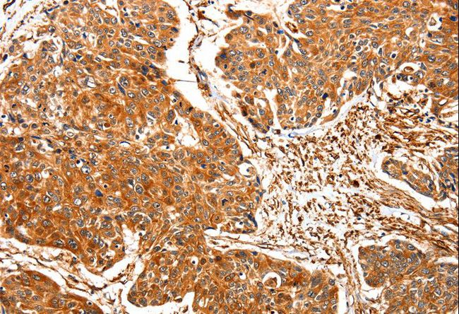 TPM2 Antibody - Immunohistochemistry of paraffin-embedded Human esophagus cancer using TPM2 Polyclonal Antibody at dilution of 1:30.