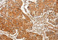 TPM2 Antibody - Immunohistochemistry of paraffin-embedded Human esophagus cancer using TPM2 Polyclonal Antibody at dilution of 1:30.