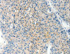 TPM2 Antibody - Immunohistochemistry of paraffin-embedded Human liver cancer using TPM2 Polyclonal Antibody at dilution of 1:60.