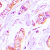 TPM2 Antibody - Immunohistochemical analysis of Tropomyosin 2 staining in human lung cancer formalin fixed paraffin embedded tissue section. The section was pre-treated using heat mediated antigen retrieval with sodium citrate buffer (pH 6.0). The section was then incubated with the antibody at room temperature and detected using an HRP conjugated compact polymer system. DAB was used as the chromogen. The section was then counterstained with hematoxylin and mounted with DPX.