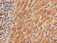 TPM3 Antibody - Immunohistochemistry of paraffin-embedded human liver cancer using TPM3 Antibody at dilution of 1:100