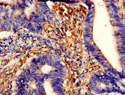 TPM3 Antibody - Immunohistochemistry of paraffin-embedded human colon cancer using TPM3 Antibody at dilution of 1:100