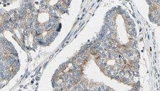 TPM3 Antibody - 1:100 staining human prostate tissue by IHC-P. The sample was formaldehyde fixed and a heat mediated antigen retrieval step in citrate buffer was performed. The sample was then blocked and incubated with the antibody for 1.5 hours at 22°C. An HRP conjugated goat anti-rabbit antibody was used as the secondary.