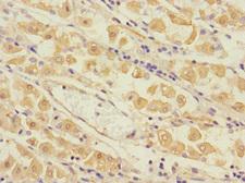 TPM4 Antibody - Immunohistochemistry of paraffin-embedded human gastric cancer at dilution 1:100