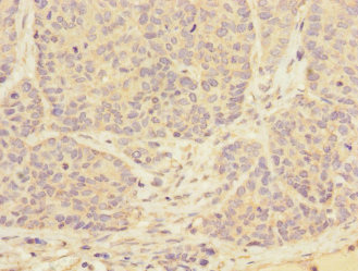 TPM4 Antibody - Immunohistochemistry of paraffin-embedded human ovarian cancer at dilution 1:100