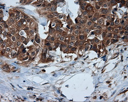 TPMT Antibody - IHC of paraffin-embedded Adenocarcinoma of breast tissue using anti-TPMT mouse monoclonal antibody. (Dilution 1:50).