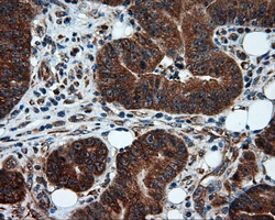 TPMT Antibody - IHC of paraffin-embedded Adenocarcinoma of colon tissue using anti-TPMT mouse monoclonal antibody. (Dilution 1:50).