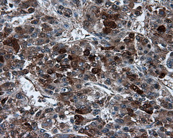 TPMT Antibody - IHC of paraffin-embedded Carcinoma of liver tissue using anti-TPMT mouse monoclonal antibody. (Dilution 1:50).