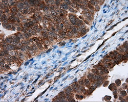 TPMT Antibody - IHC of paraffin-embedded Adenocarcinoma of ovary tissue using anti-TPMT mouse monoclonal antibody. (Dilution 1:50).